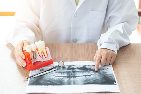 Benefícios do implante dentário: mais autoestima e qualidade de vida