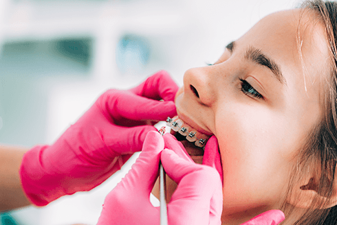 5 dúvidas sobre aparelho ortodôntico para crianças