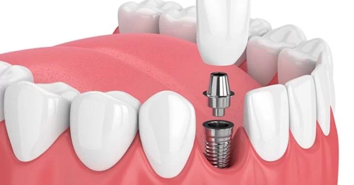 Implante Dentário é com a Sempre Sorrindo: a maior rede odontológica do interior de SP oferece o tratamento que transforma sorrisos