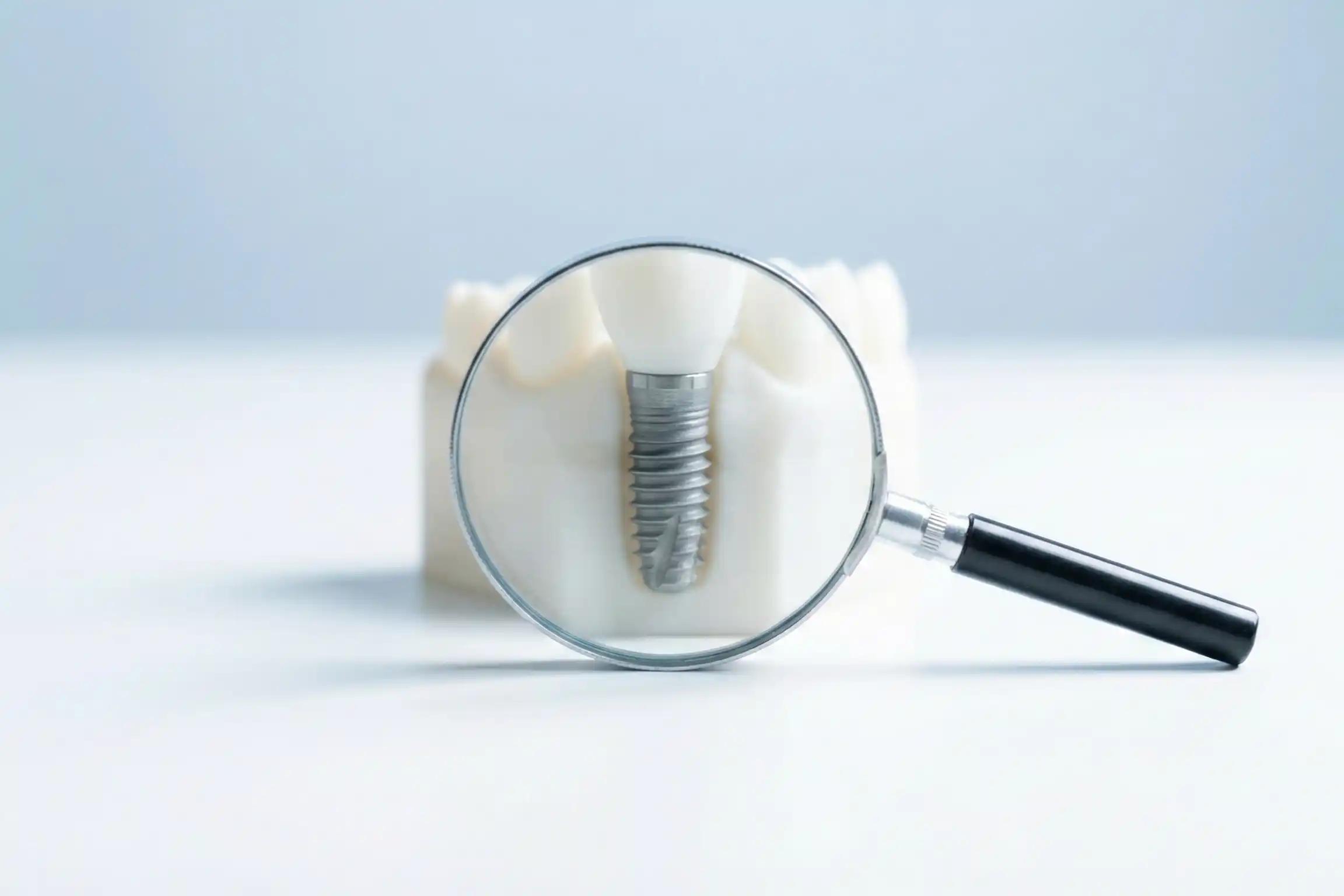 7 Mitos e Verdades sobre Implantes Dentários: O Que Ninguém Te Conta