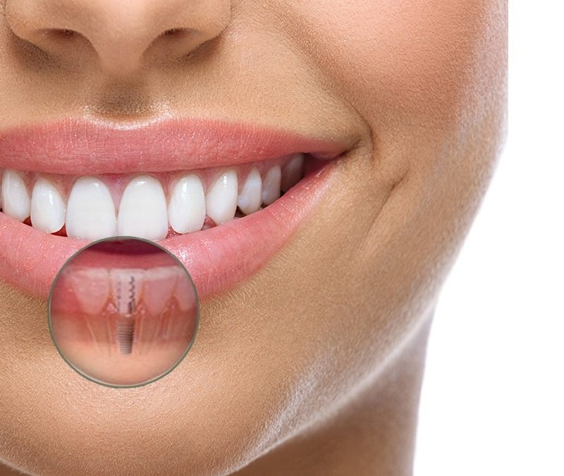 O que é Implante Dentário? Tire todas as suas dúvidas sobre esse tratamento que transforma sorrisos