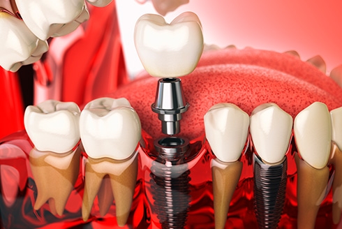 Saiba tudo sobre implante dentário